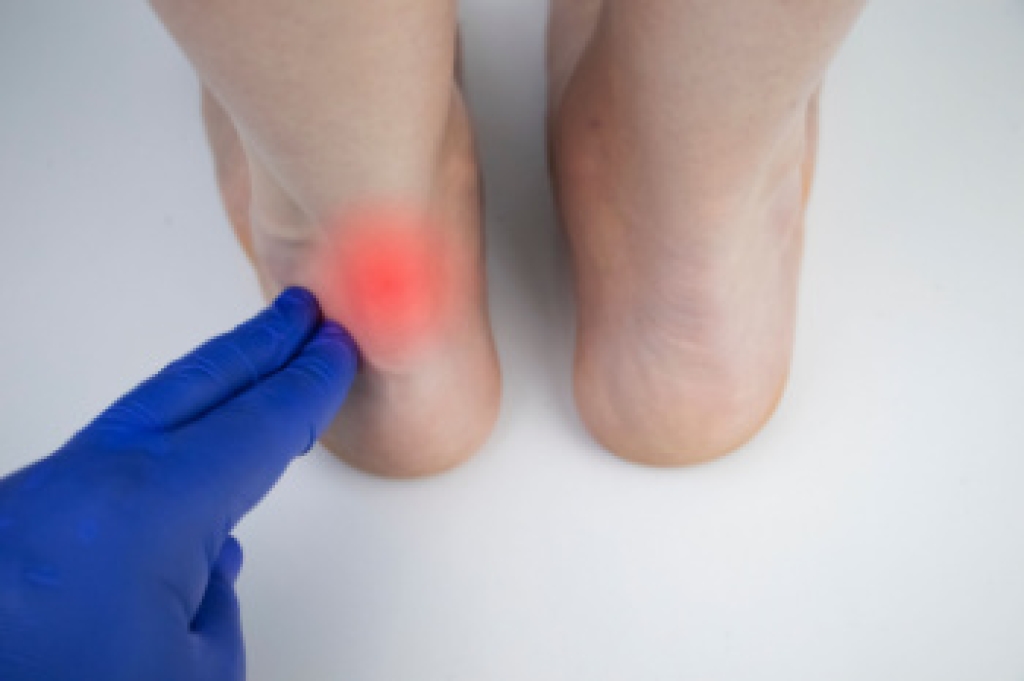 Acute and Chronic Achilles Tendon Conditions