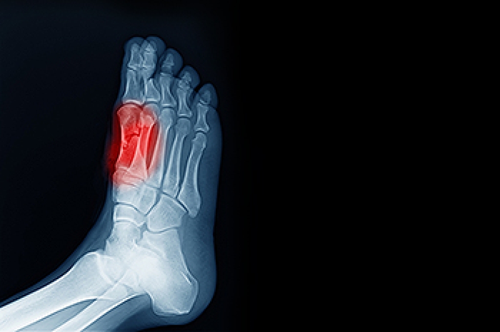 Understanding Sesamoiditis and Forefoot Pain