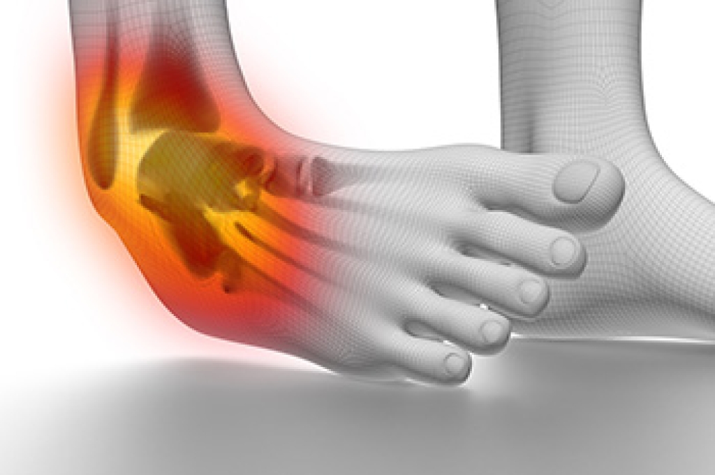 Ankle Sprains in Children