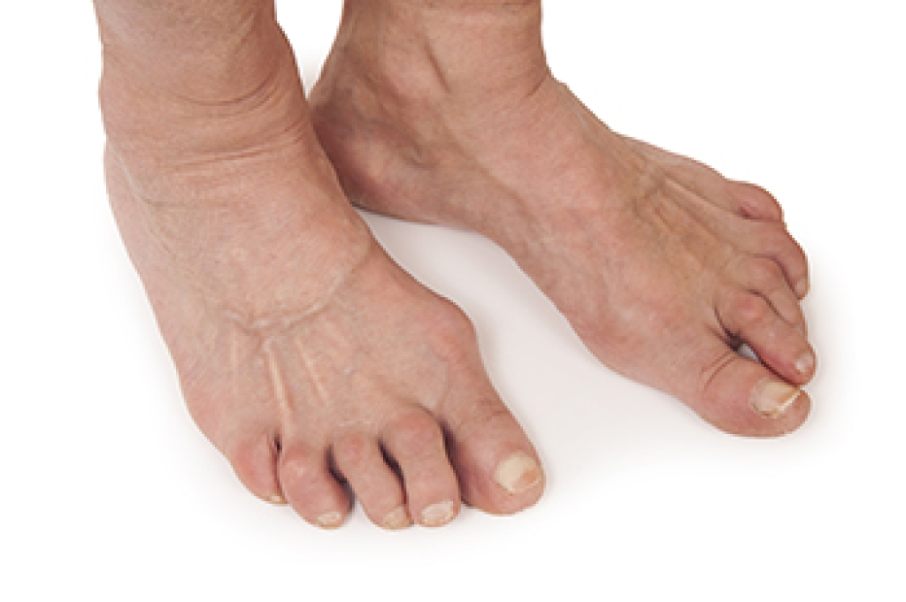 Rheumatoid Arthritis and Its Impact on Foot Health
