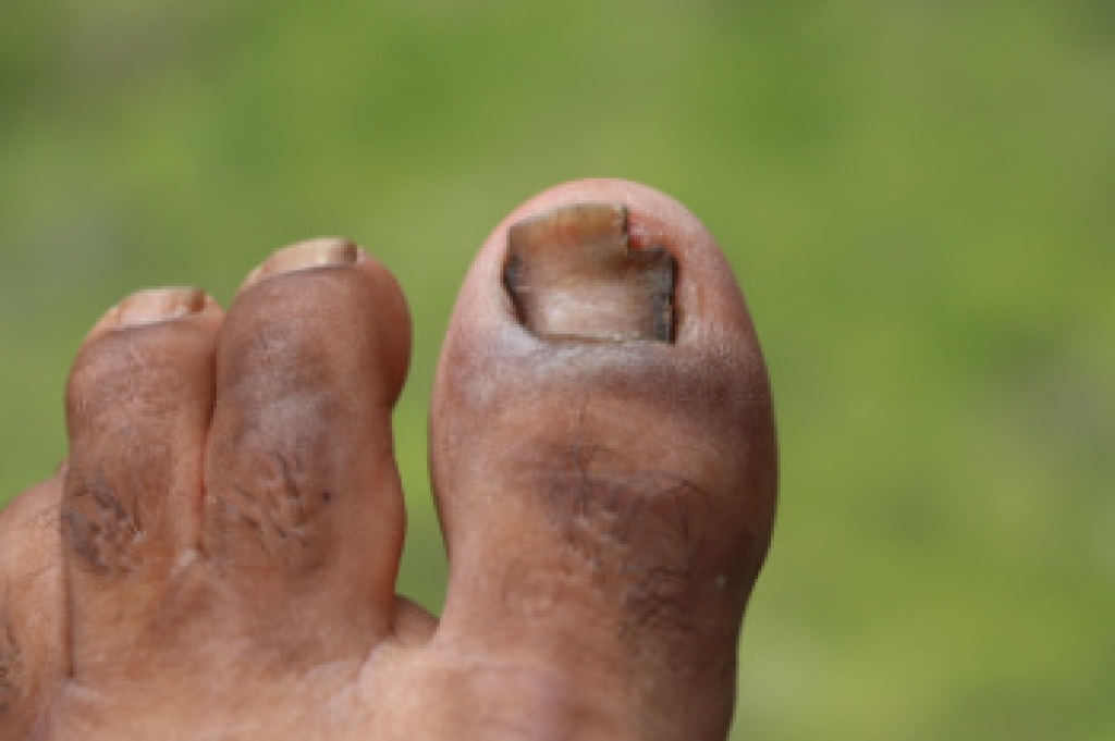 How Toenail Fungus Can Spread