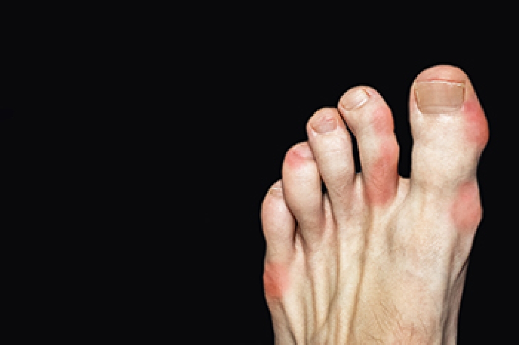 When Gout Pain Strikes at Night