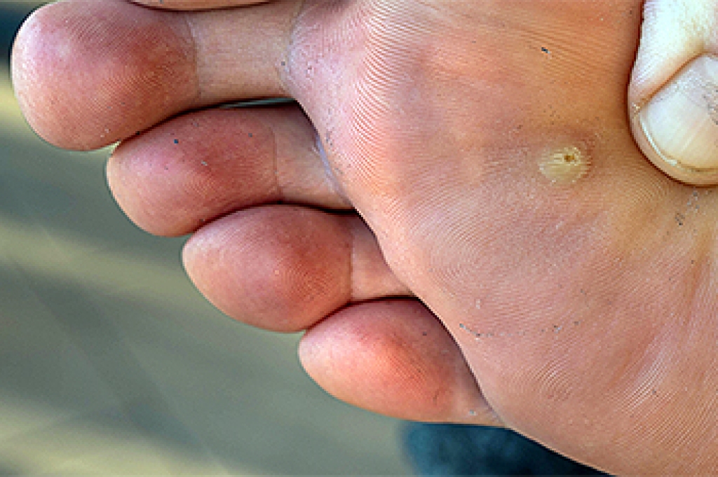 How to Recognize and Treat Plantar Warts