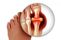 All About Gout
