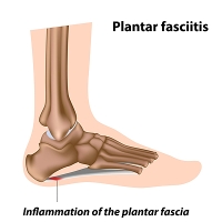 How Does Plantar Fasciitis Make the Heel Hurt?